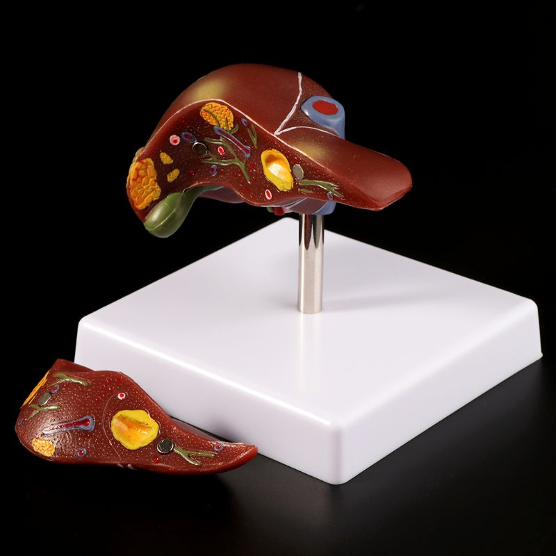 Medical Lab Assistant - Human Liver Pathological Anatomical Model Anatomy